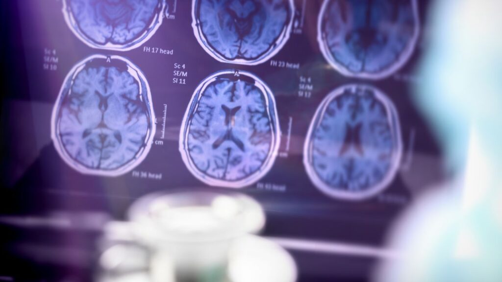 Alzheimer-disease-stages